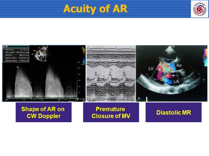 Acuity of AR Shape of AR on  CW Doppler Premature  Closure of
